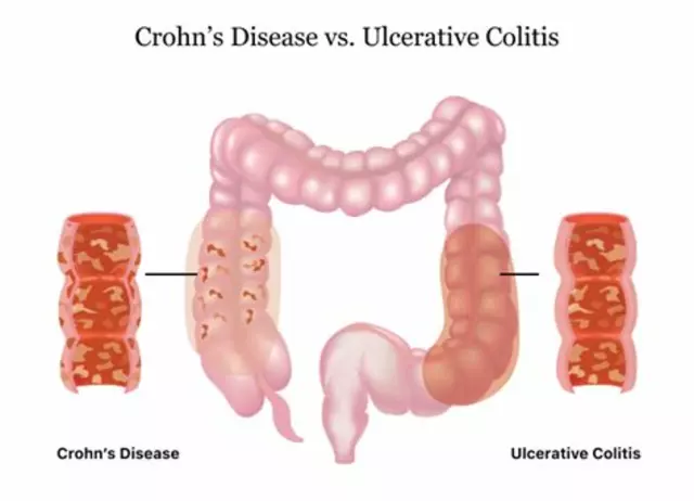 The Link Between Crohn's Disease and Gluten Intolerance: What to Watch For