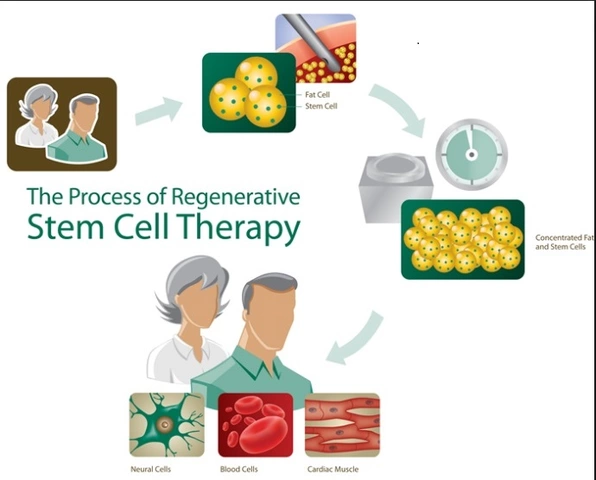 Melphalan and Stem Cell Transplantation: A Powerful Combination