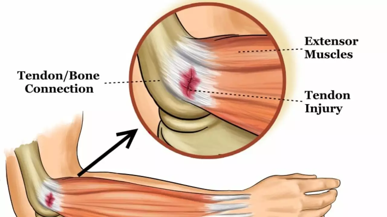 Tendonitis in Swimmers: Causes, Symptoms, and Treatments